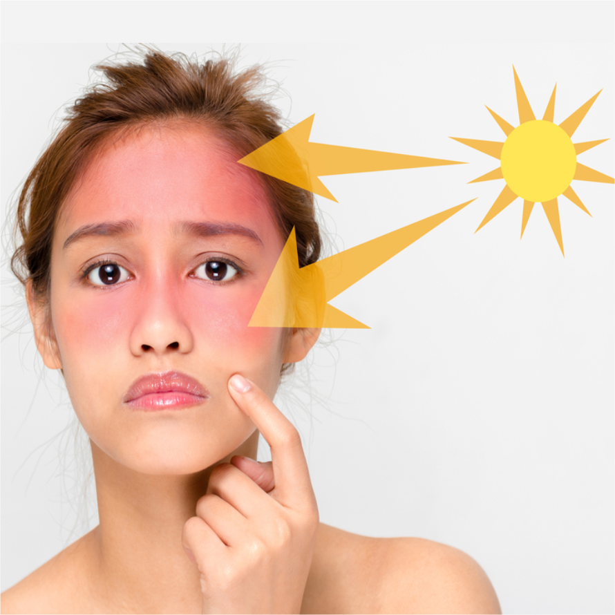 Sunburn Studies Centre For Cruelty Free Testing Sunburn studies centre for cruelty free testing