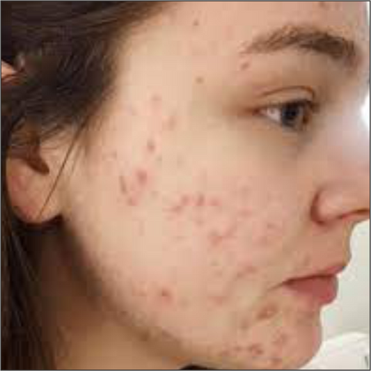 Anti acne Study- P.Acne