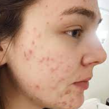 Anti-acne /Anti-sebum