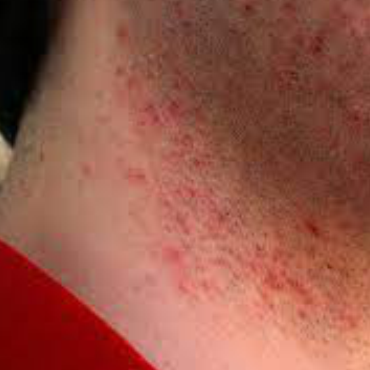 Shaving irritations
