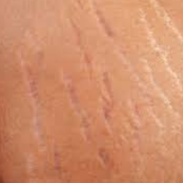 Anti-stretch marks