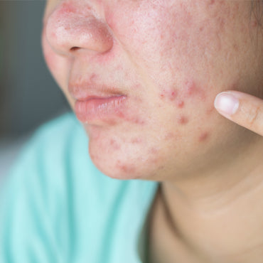 Skin Irritation