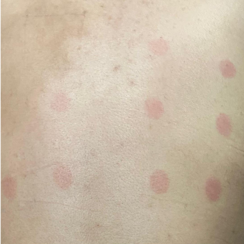 Sunburn Studies - Anti - Erythema Study